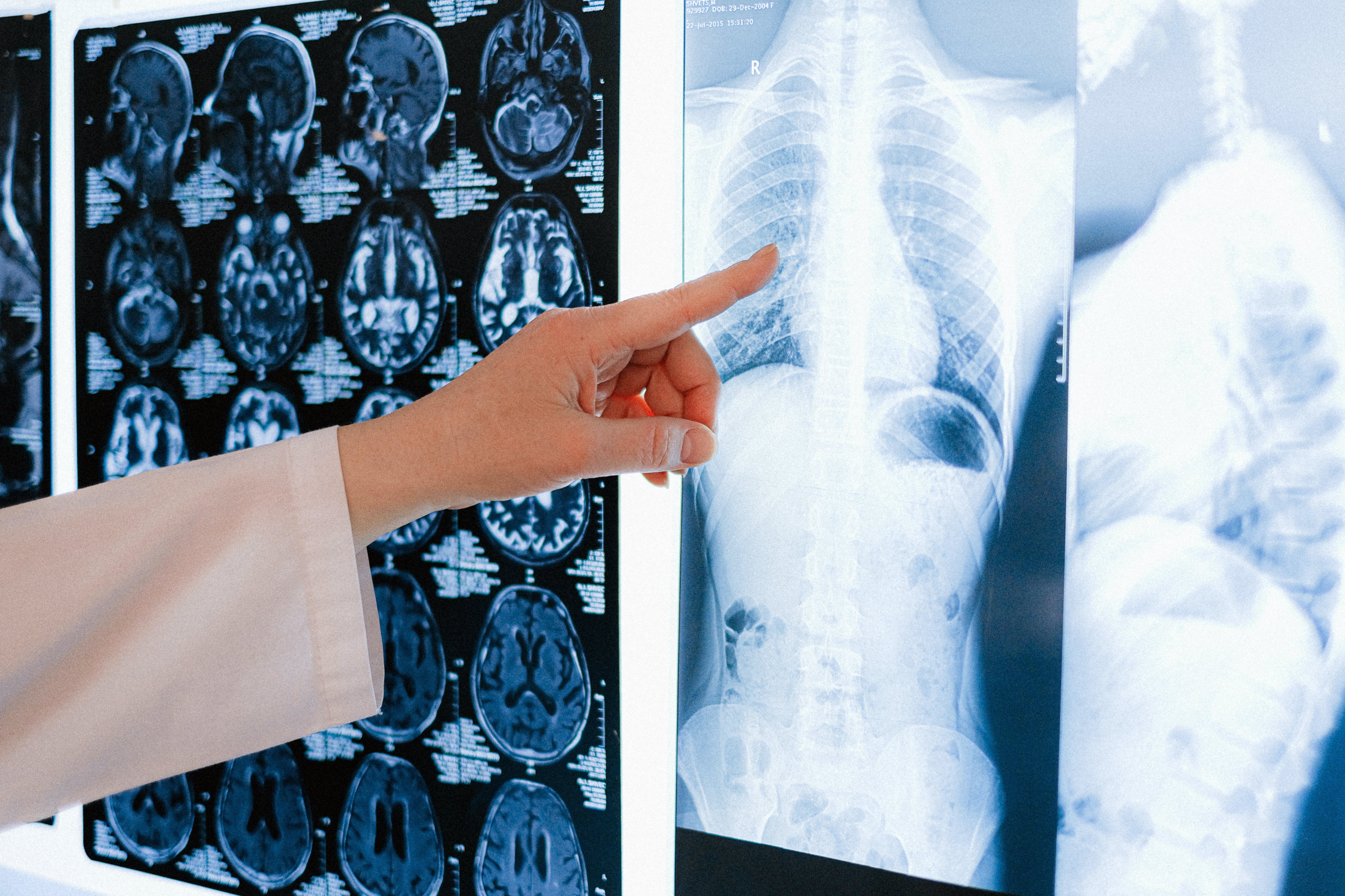 Beacon stresses the need to raise awareness about lung complications.